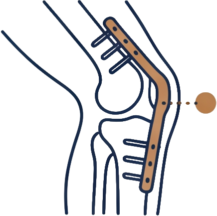 Line illustration of an orthopaedic knee implant